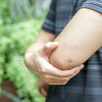 A person wearing a gray striped shirt holds their right elbow, which has a small, round, reddish bump on the skin—possibly the result of a brown recluse bite. Green plants are blurred in the background.