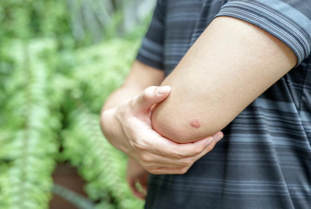 Featured image for Brown Recluse Bite: Symptoms and Effective Treatment