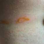 A close-up of human skin with a small, irregularly shaped orange discoloration and faint redness—common in the early bite stages of a Brown Recluse bite. A hand is lightly pulling the skin to the side for better examination and possible treatment.