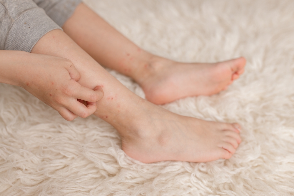 A child sits on a white, fluffy carpet and scratches red spots on their lower leg—signs that could point to fleas on humans. The irritated skin shows small red bumps and marks, highlighting the importance of flea prevention.