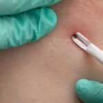 A close-up view of a gloved hand using a white tool to remove a tick embedded in human skin. The red, swollen skin highlights the importance of tick and flea prevention, since fleas on humans can also cause irritation.