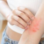 A person scratches the inside of their forearm, showing red, irritated patches—possible symptoms of an earwig bite. The person is wearing a white top and blue jeans, with the background out of focus.