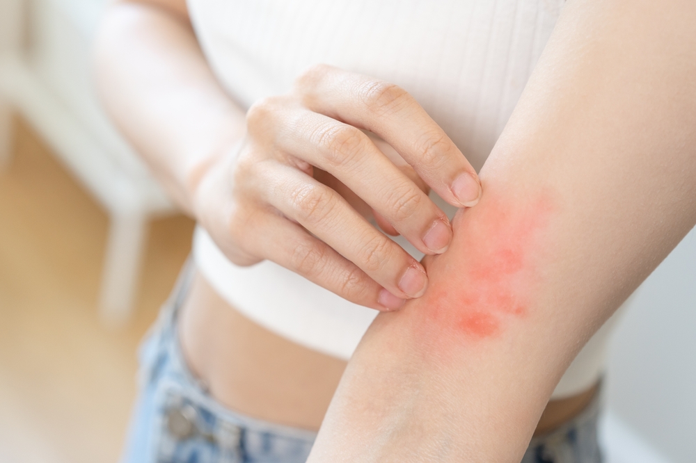 Featured image for Earwig Bite Guide: Symptoms, Care & Prevention Tips