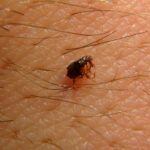 A close-up of a small dark brown flea on human skin, surrounded by fine body hair, offering insight into fleas on humans and highlighting the importance of effective flea removal tips.
