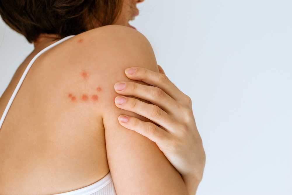 Featured image for Do Pincher Bugs Bite? Symptoms, Treatment, and Prevention